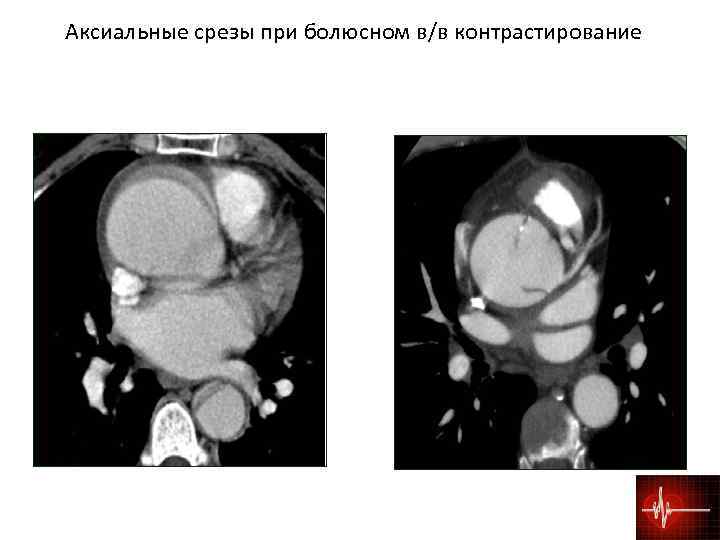  Аксиальные срезы при болюсном в/в контрастирование 