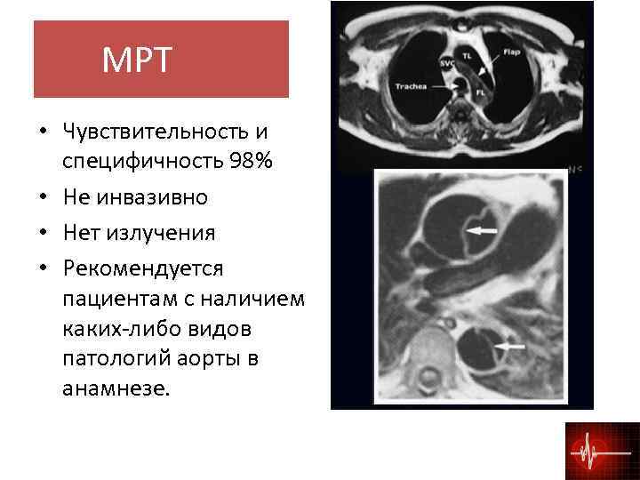  МРТ • Чувствительность и специфичность 98% • Не инвазивно • Нет излучения •