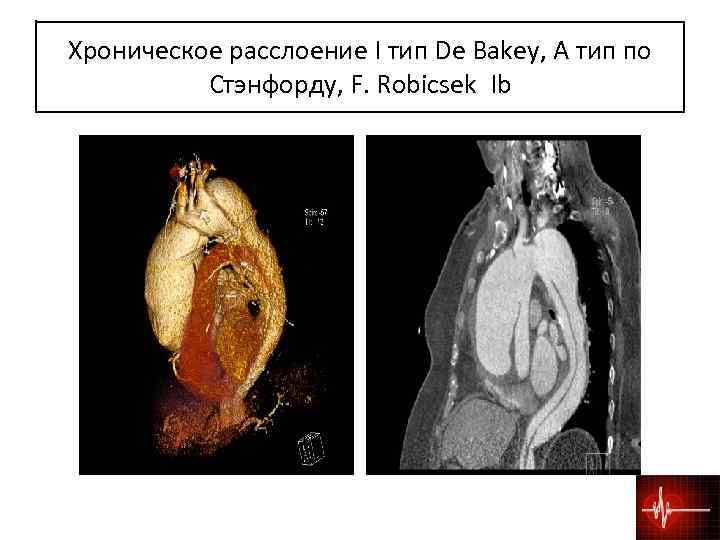 Хроническое расслоение I тип De Bakey, А тип по Стэнфорду, F. Robicsek Ib 