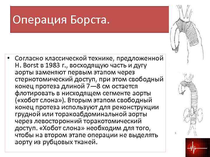 Аневризма восходящей аорты операция