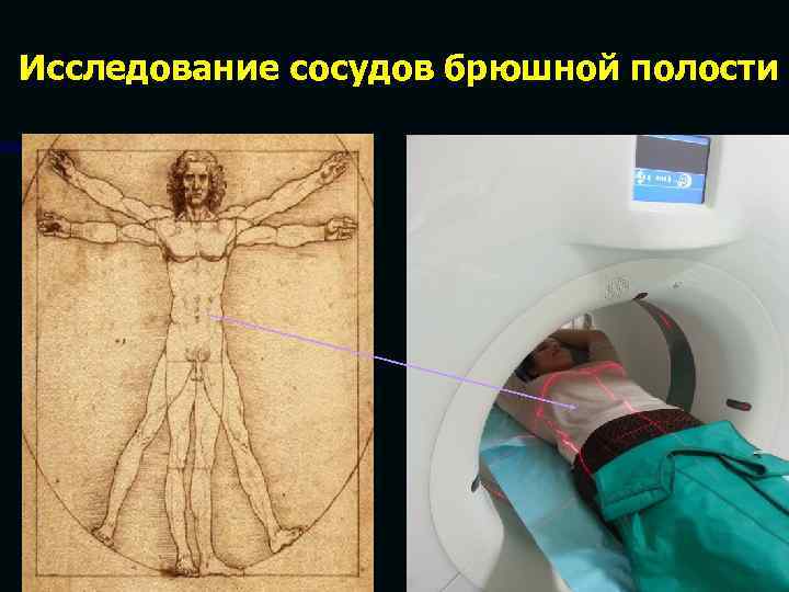 Исследование сосудов брюшной полости 