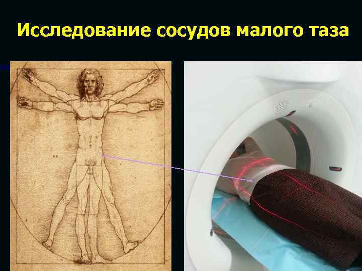 Исследование сосудов малого таза 