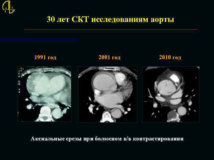 30 лет СКТ исследованиям аорты 1991 год 2001 год 2010 год Аксиальные срезы при
