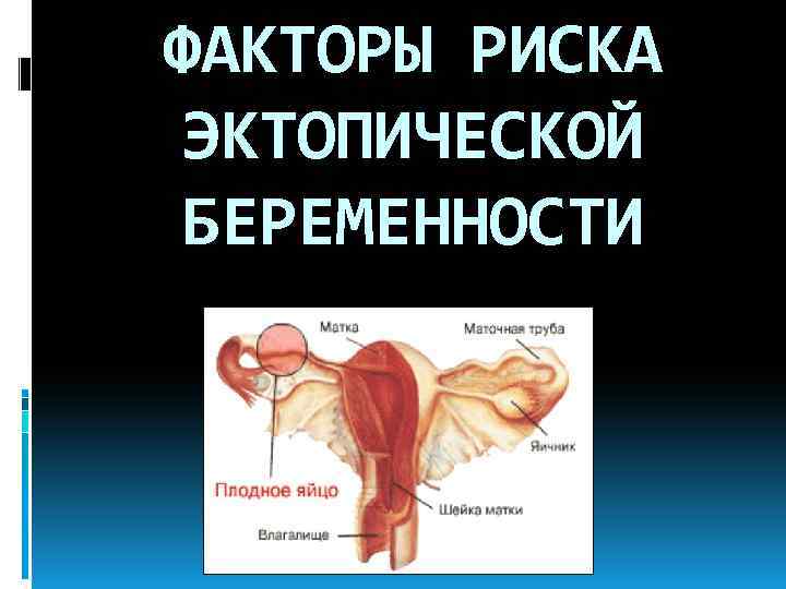 ФАКТОРЫ РИСКА ЭКТОПИЧЕСКОЙ БЕРЕМЕННОСТИ 