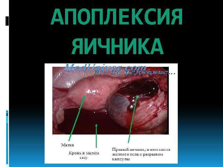 АПОПЛЕКСИЯ ЯИЧНИКА 
