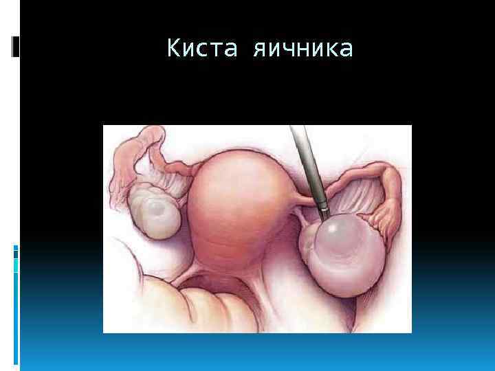 Киста яичника 