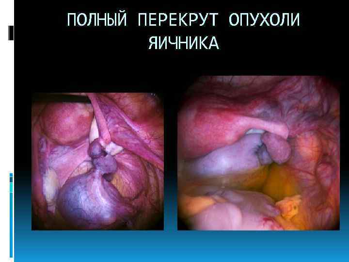 ПОЛНЫЙ ПЕРЕКРУТ ОПУХОЛИ ЯИЧНИКА 