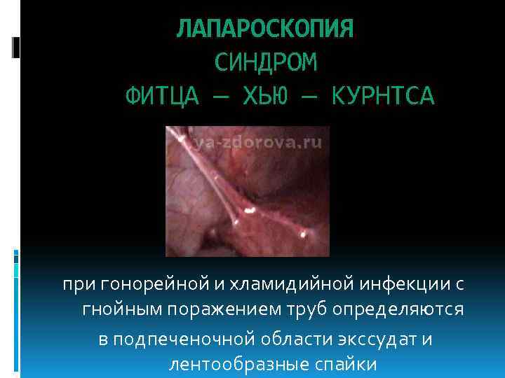 ЛАПАРОСКОПИЯ СИНДРОМ ФИТЦА — ХЬЮ — КУРНТСА при гонорейной и хламидийной инфекции с гнойным