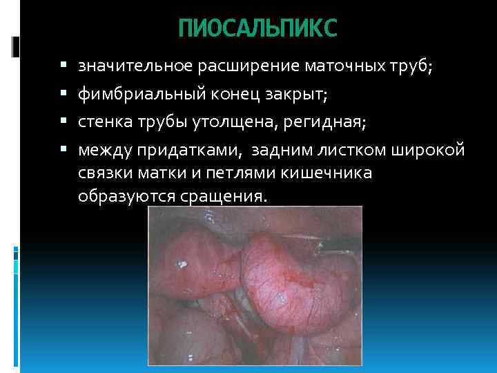 ПИОСАЛЬПИКС значительное расширение маточных труб; фимбриальный конец закрыт; стенка трубы утолщена, регидная; между придатками,