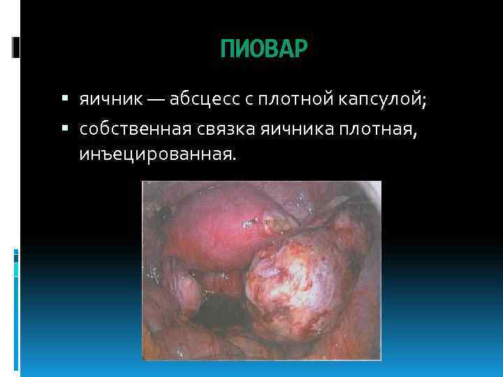 ПИОВАР яичник — абсцесс с плотной капсулой; собственная связка яичника плотная, инъецированная. 