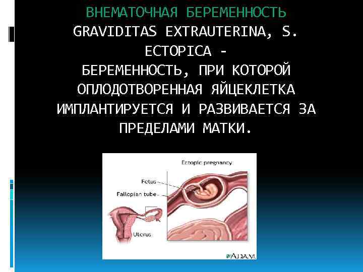 ВНЕМАТОЧНАЯ БЕРЕМЕННОСТЬ GRAVIDITAS EXTRAUTERINA, S. ECTOPICA - БЕРЕМЕННОСТЬ, ПРИ КОТОРОЙ ОПЛОДОТВОРЕННАЯ ЯЙЦЕКЛЕТКА ИМПЛАНТИРУЕТСЯ И