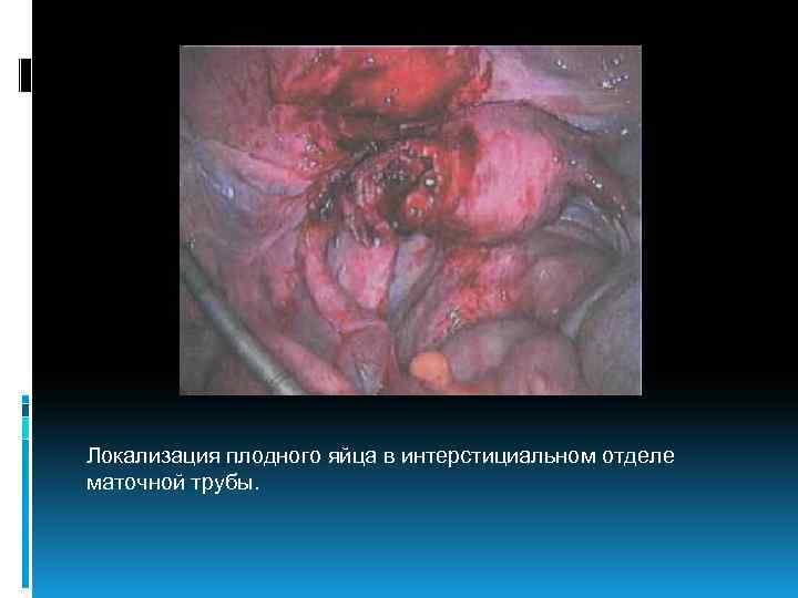 Локализация плодного яйца в интерстициальном отделе маточной трубы. 