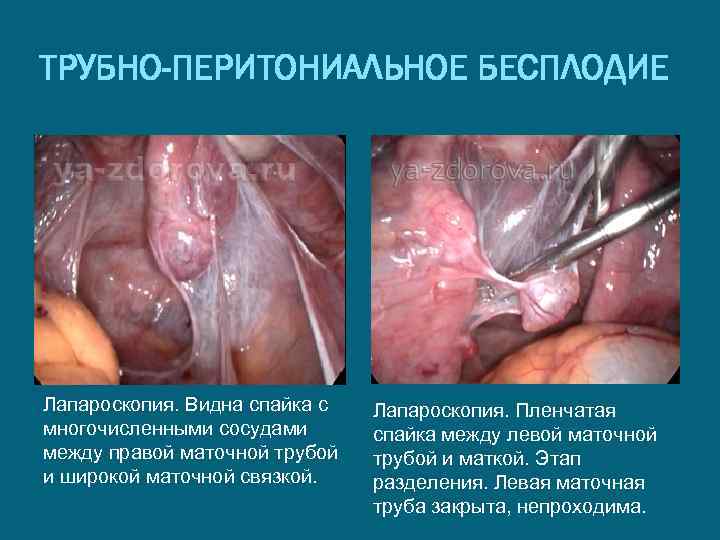 ТРУБНО-ПЕРИТОНИАЛЬНОЕ БЕСПЛОДИЕ Лапароскопия. Видна спайка с многочисленными сосудами между правой маточной трубой и широкой