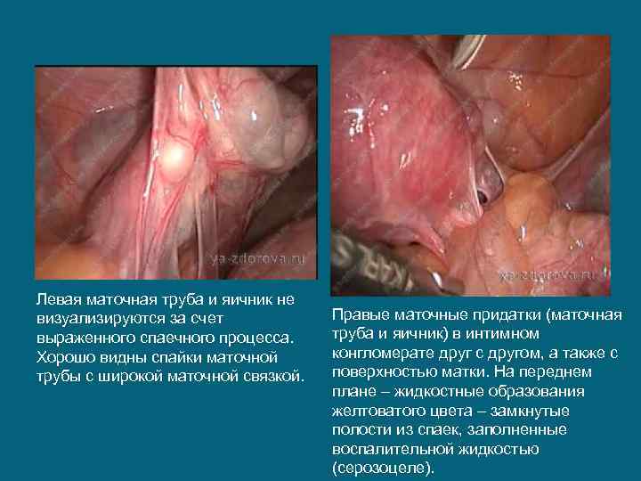 Левая маточная труба и яичник не визуализируются за счет выраженного спаечного процесса. Хорошо видны