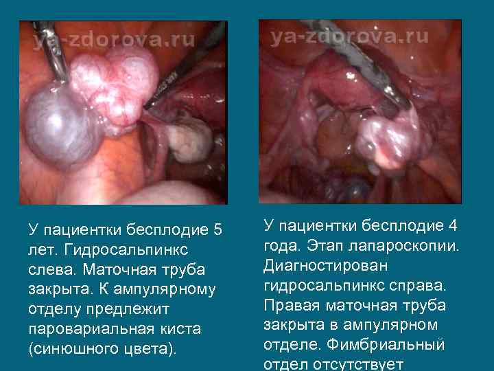У пациентки бесплодие 5 лет. Гидросальпинкс слева. Маточная труба закрыта. К ампулярному отделу предлежит