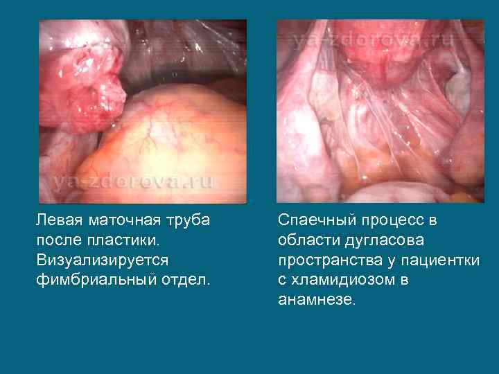 Левая маточная труба после пластики. Визуализируется фимбриальный отдел. Спаечный процесс в области дугласова пространства