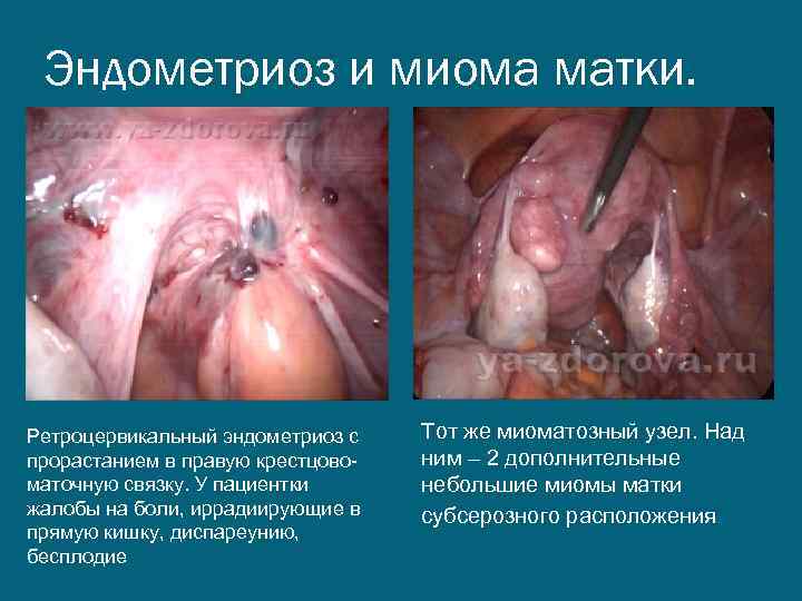 Эндометриоз и миома матки. Ретроцервикальный эндометриоз с прорастанием в правую крестцовоматочную связку. У пациентки