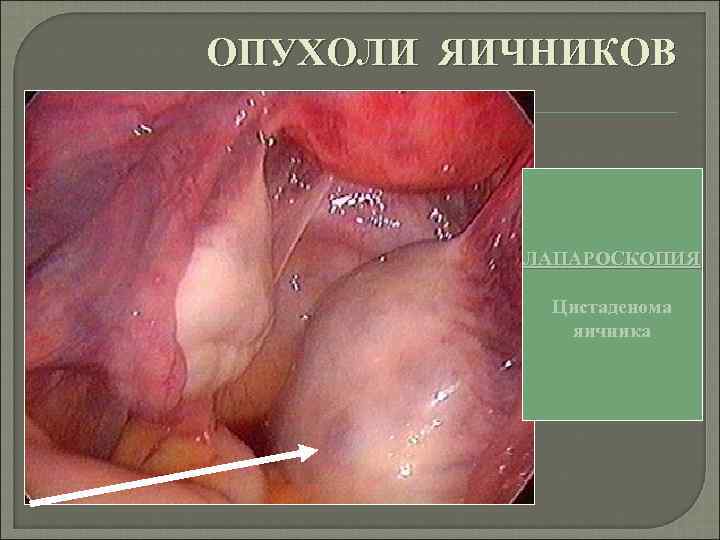 ОПУХОЛИ ЯИЧНИКОВ ЛАПАРОСКОПИЯ Цистаденома яичника 