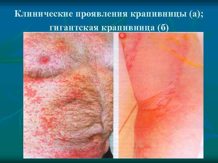 Клинические проявления крапивницы (а); гигантская крапивница (б) 
