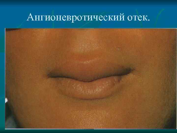 Ангионевротический отек. 