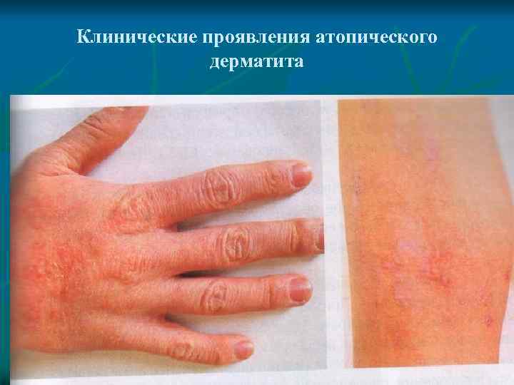 Клинические проявления атопического дерматита 