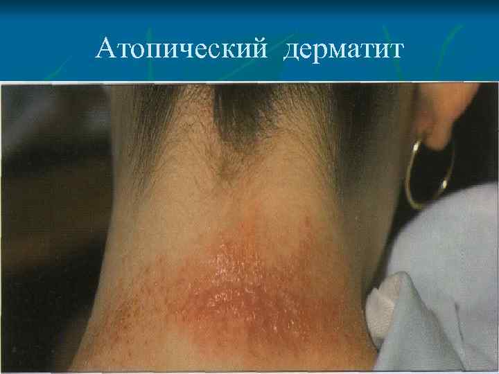 Атопический дерматит 