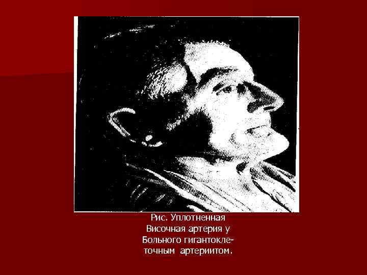 Рис. Уплотненная Височная артерия у Больного гигантокле точным артериитом. 