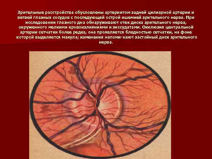 Зрительные расстройства обусловлены артериитом задней цилиарной артерии и ветвей глазных сосудов с последующей острой