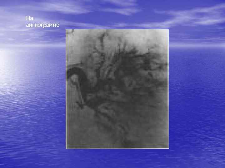 На ангиограмме 