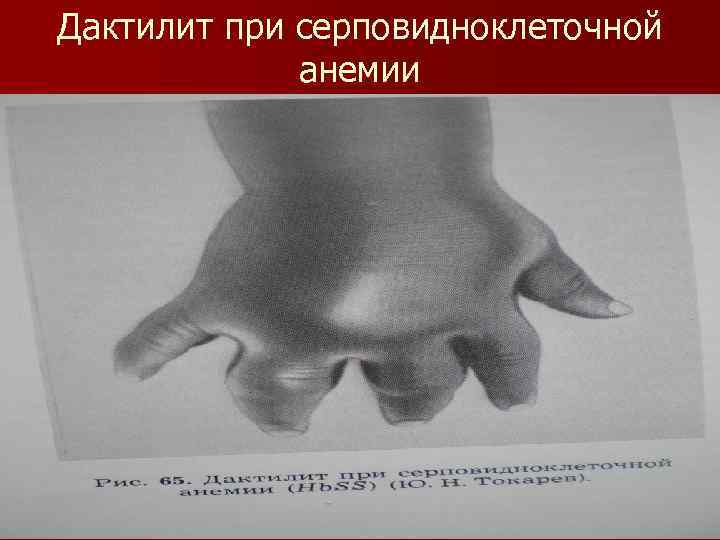 Дактилит при серповидноклеточной анемии 