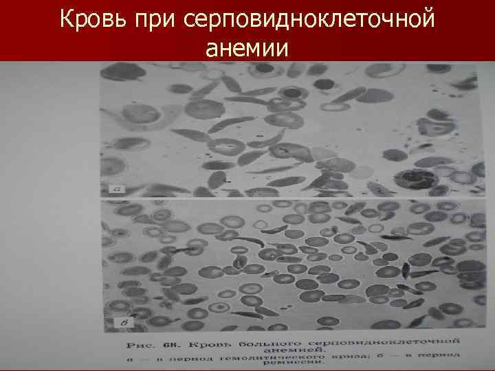 Кровь при серповидноклеточной анемии 