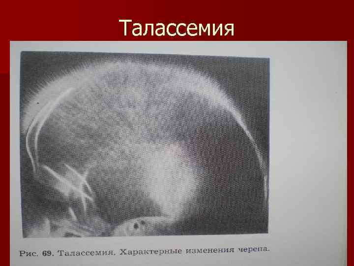 Талассемия 