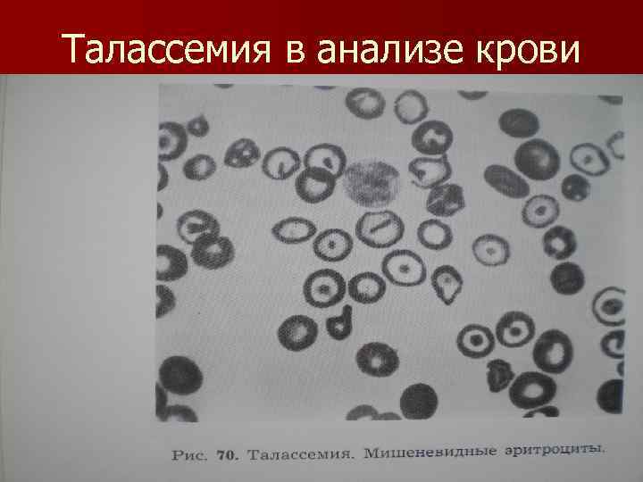 Талассемия в анализе крови 