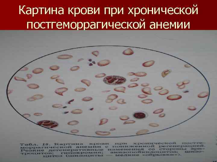 Картина крови при хронической постгеморрагической анемии