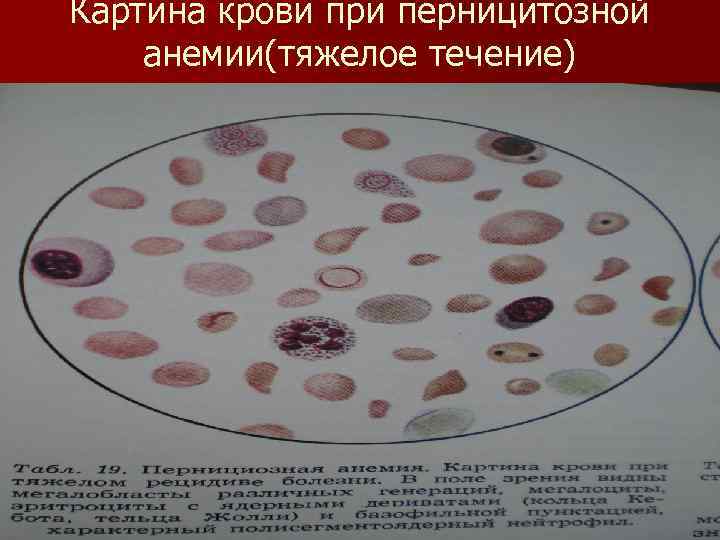 Картина крови при перницитозной анемии(тяжелое течение) 