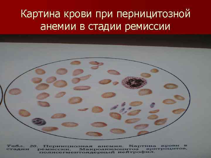 Картина крови при перницитозной анемии в стадии ремиссии 