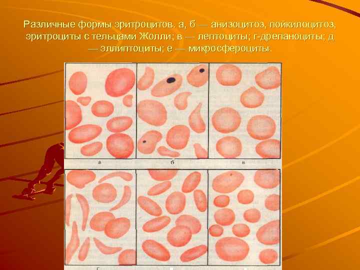 Различные формы эритроцитов. а, б — анизоцитоз, пойкилоцитоз, эритроциты с тельцами Жолли; в —