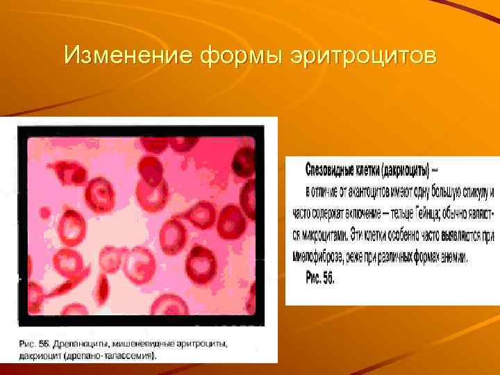 Изменение формы эритроцитов 