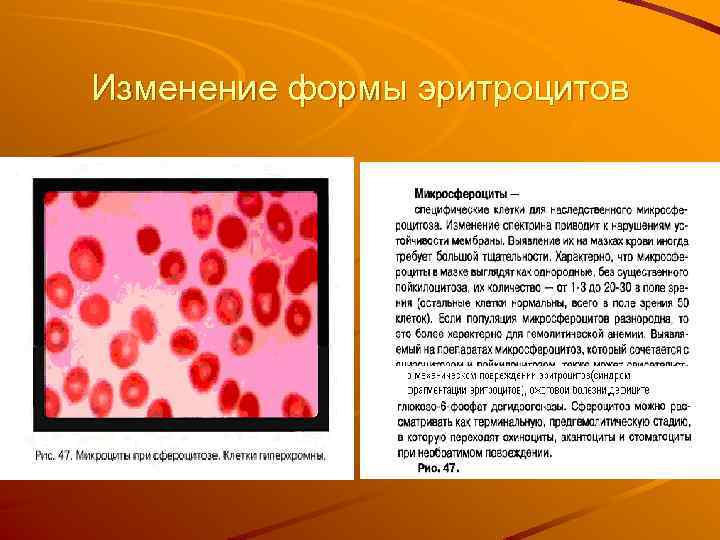 Изменение формы эритроцитов 