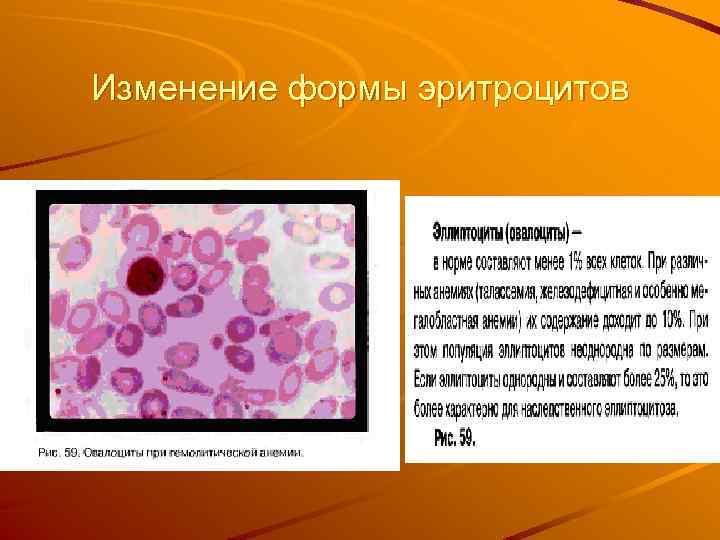 Изменение формы эритроцитов 