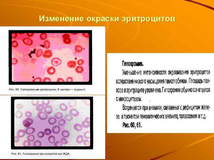 Изменение окраски эритроцитов 
