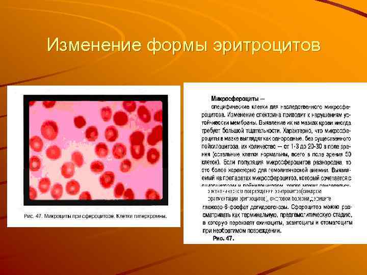 Изменение формы эритроцитов 