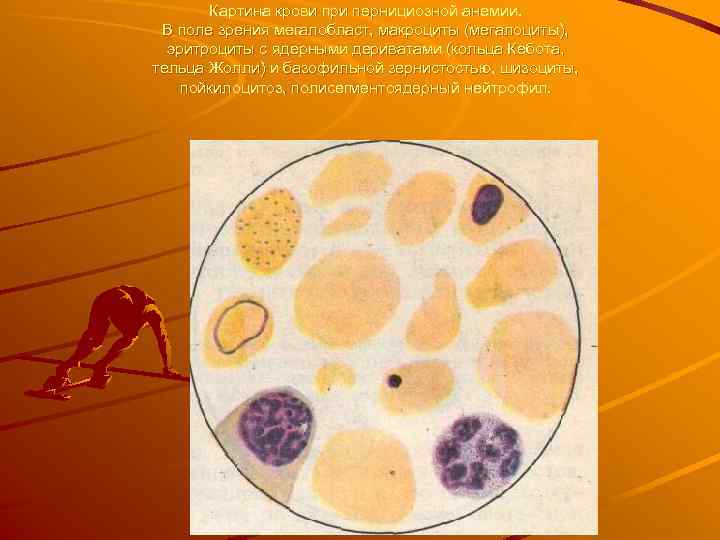 Картина крови при пернициозной анемии. В поле зрения мегалобласт, макроциты (мегалоциты), эритроциты с ядерными