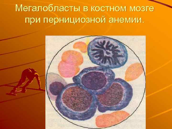 Мегалобласты в костном мозге при пернициозной анемии. 