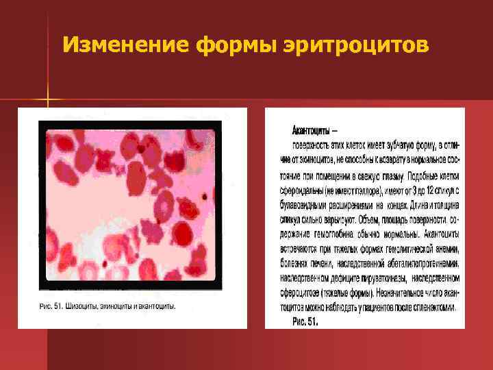 Изменение формы эритроцитов 