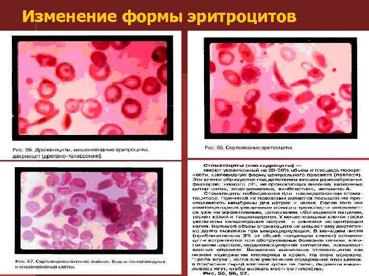 Изменение формы эритроцитов 