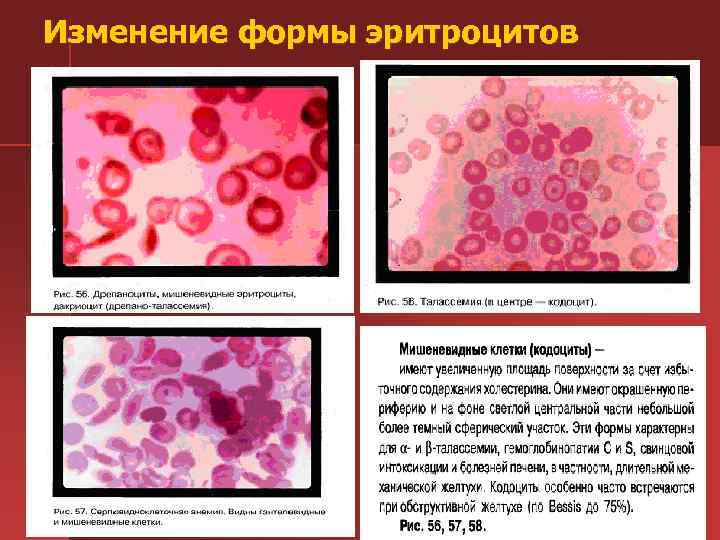 Изменение формы эритроцитов 