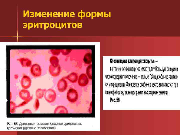 Изменение формы эритроцитов 