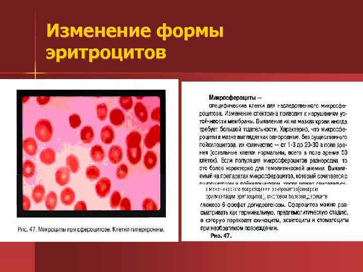 Изменение формы эритроцитов 