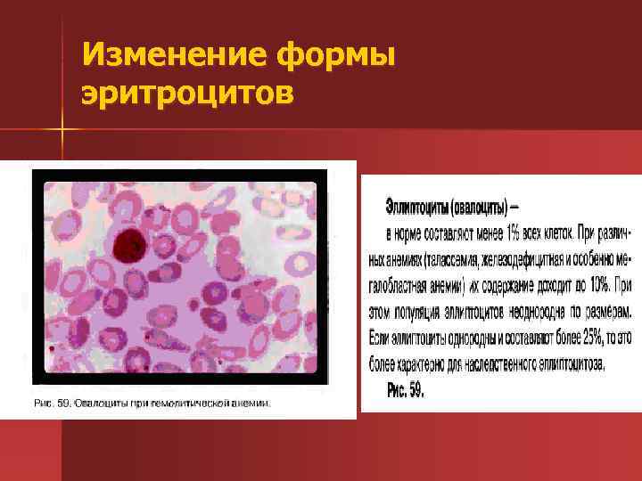 Изменение формы эритроцитов 